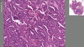 Endometrial Adenocarcinoma  Histopathology [upl. by Publius379]