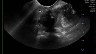 Peritonsillar Abscess Needle Drainage US JETem 2017 [upl. by Tunk]