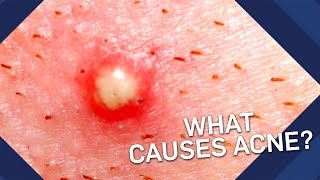 What Causes Acne  Earth Science [upl. by Bennion450]