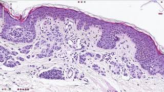 Compound Melanocytic Nevus  Histopathology [upl. by Shaeffer]