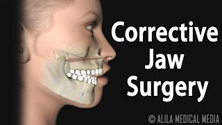 Corrective Jaw Orthognathic Surgery Animation [upl. by Eleda639]