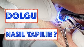 Dolgu Nasıl Yapılır [upl. by Erbes]