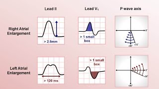 Intro to EKG Interpretation  Chamber Enlargement [upl. by Marcin503]