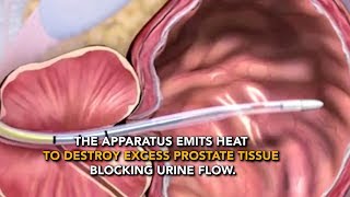 Transurethral microwave thermotherapy TUMT  Usapang Pangkalusugan [upl. by Vanderhoek974]