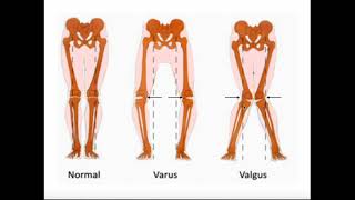 Valgus amp Varus Forces on the Knee  MCL vs LCL Injuries [upl. by Humo20]