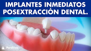 Implantes dentales inmediatos posextracción dental © [upl. by Armalla]