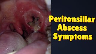 Peritonsillar Abscess Symptoms [upl. by Attolrahc427]