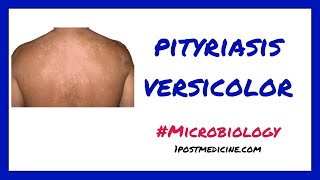 Pityriasis Versicolor  Microbiology [upl. by Annaitsirk181]