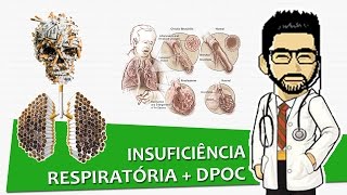 INSUFICIENCIA RESPIRATORIA AGUDA  Fisiopatología Parte 2 [upl. by Ariayek]