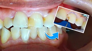 Reconstruccion diente con caries [upl. by Aznecniv]