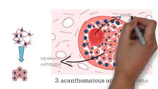 Ameloblastoma part 2 [upl. by Thedric]