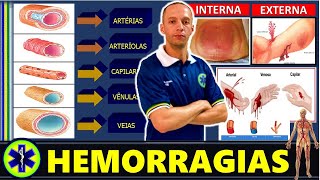 HEMORRAGIAS QUAIS SÃO OS DIFERENTES TIPOS [upl. by Nnalyrehs]