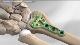 Distal Radius Fracture Repair  Volar Plate [upl. by Leihcey]