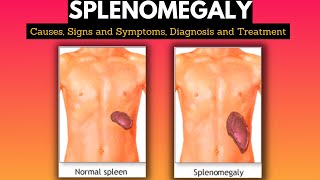 Splenomegaly Causes Signs and Symptoms Diagnosis and Treatment [upl. by Eicaj122]