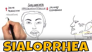 Sialorrhea  Drooling  Causes Clinical features and Treatment [upl. by Norvall]