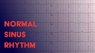 Normal Sinus Rhythm  EKG ECG Interpretation [upl. by Alemaj]