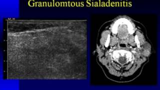 Ultrasound Imaging of the Salivary Glands [upl. by Ednargel645]