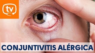 Claves sobre la conjuntivitis alérgica [upl. by Aihsenor787]