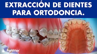 Extracción de dientes en ortodoncia © [upl. by Ichabod620]