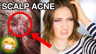 SCALP ACNE amp ITCHY DANDRUFF  How To Get Rid of It Completely [upl. by Noreen]