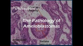 The Pathology of Ameloblastomas [upl. by Naujud]