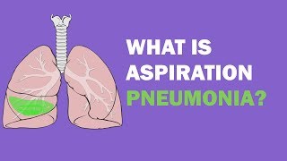 Needle Aspiration of a Pneumothorax [upl. by Nnylrefinnej]