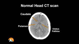 Normal Head CT Scan Anatomy Made Simple Neuroradiology [upl. by Nahsin]