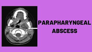 Parapharyngeal Abscess [upl. by Allekim]