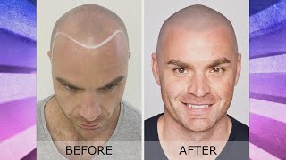 Scalp ‘Hair’ Tattoos for Balding Men [upl. by Pardew469]