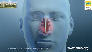 Nasal Turbinate Reduction – CIMS Hospital [upl. by Oranneg]