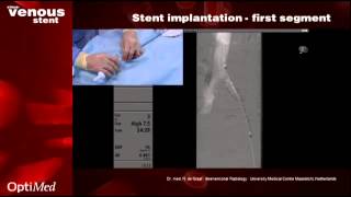 sinusVenous stent in practice [upl. by Aedrahs]