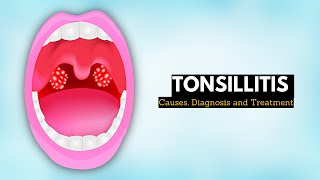 Tonsillitis Causes Signs and Symptoms Diagnosis and Treatment [upl. by Nybor]