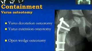 Perthes Disease [upl. by Aneehc332]