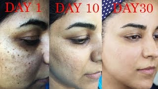 How I Got Rid of Dark Scars Hyperpigmentation PimplesAcne [upl. by Anait828]