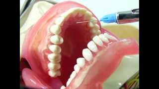 Maxillary Infiltration Technique [upl. by Norted]