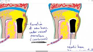 Systemic pathology 34  bone 4  osteomyelitis  DRSAMEH GHAZY [upl. by Murton]