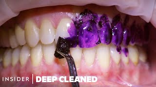 How Teeth Are Professionally Deep Cleaned  Deep Cleaned [upl. by Dibri]