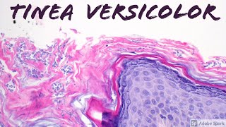 Tinea VersicolorPityriasis Versicolor Malassezia aka Pityrosporum Skin Infection Dermatology [upl. by Llenrag389]