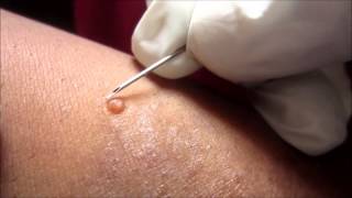 Removing H P Body From Molluscum Contagiosum [upl. by Accire]