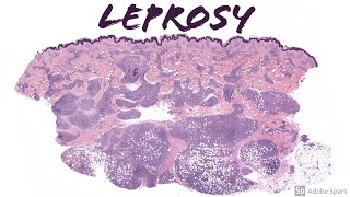 Lepromatous Leprosy Hansen Disease 5Minute Pathology Pearls [upl. by Notyad30]