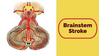 Brainstem Stroke Syndromes [upl. by Vashtee]