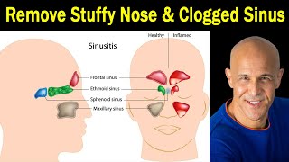 How to Relieve a Stuffy Nose with Acupressure [upl. by Otrebide566]