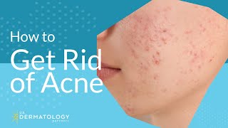 Acne Treatment  Explained by Dermatologist [upl. by Mariellen]