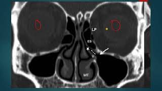 OSTEOMEATAL COMPLEX UNIT OMC ON CT ANATOMY SIMPLIFIED [upl. by Niabi78]