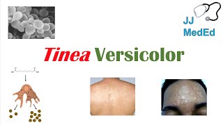 “Fungal Skin Infection of Many Colors” Tinea Versicolor  Pathogenesis Symptoms and Treatment [upl. by Dara]