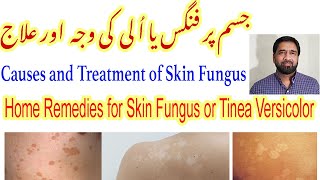 Fungal Skin Infection  Fungal Infection  Tinea Versicolor Treatment  Skin Fungus Yeast Infection [upl. by Brom938]