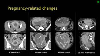 Gynecologic Radiology Anatomy [upl. by Torrie178]