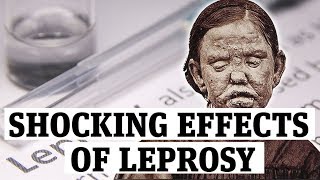 The shocking effects of leprosy [upl. by Zeta472]