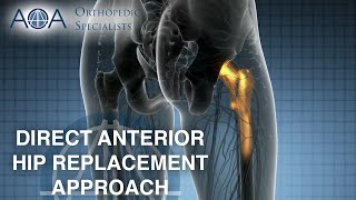 AOA Orthopedic Specialists  Direct Anterior Hip Replacement Approach [upl. by Salokin405]