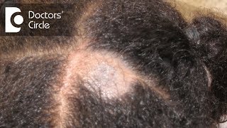 What causes Scalp Ringworm Effective Treatment   Tinea Capitis  Dr Tina Ramachander [upl. by Annayd]